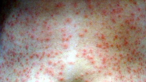 Why did I get a Rash from my Hot Tub?