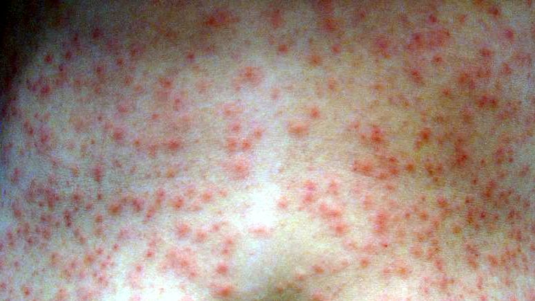 A hot tub rash is usually caused by inadequate sanitizer which leads to ...